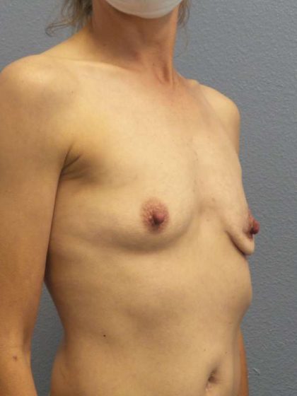 Asymmetric (Uneven) Breasts Before & After Patient #7024