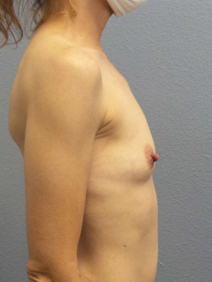 Asymmetric (Uneven) Breasts Before & After Patient #7024