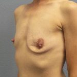 Asymmetric (Uneven) Breasts Before & After Patient #7024