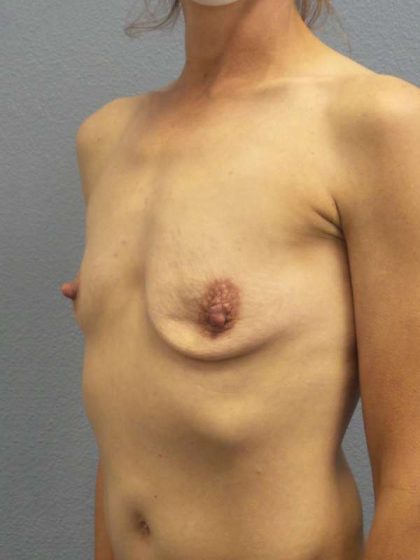 Asymmetric (Uneven) Breasts Before & After Patient #7024