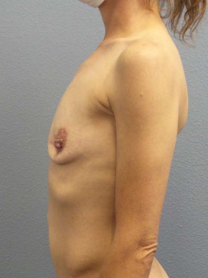 Asymmetric (Uneven) Breasts Before & After Patient #7024