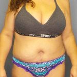 Abdominoplasty Before & After Patient #6797