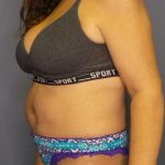 Abdominoplasty Before & After Patient #6797