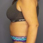 Abdominoplasty Before & After Patient #6797