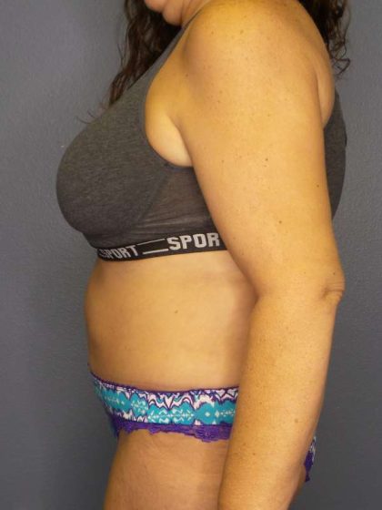 Abdominoplasty Before & After Patient #6797