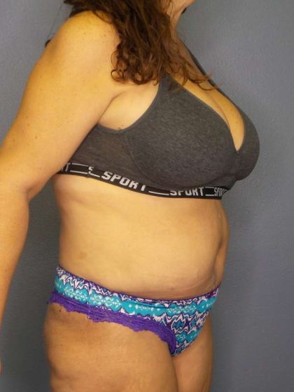 Abdominoplasty Before & After Patient #6797
