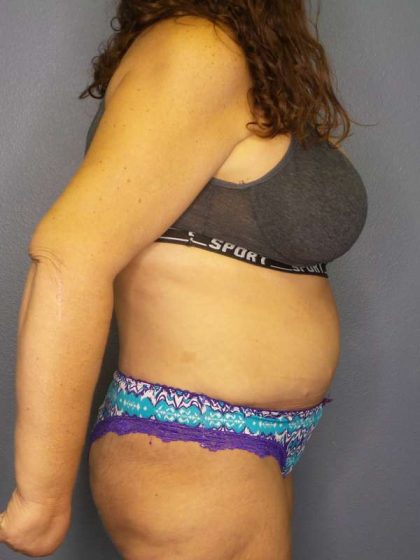 Abdominoplasty Before & After Patient #6797