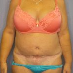 Abdominoplasty Before & After Patient #6797