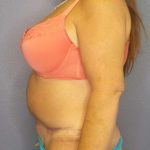Abdominoplasty Before & After Patient #6797