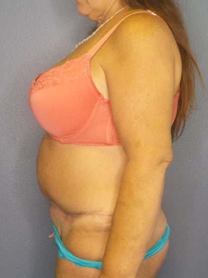 Abdominoplasty Before & After Patient #6797