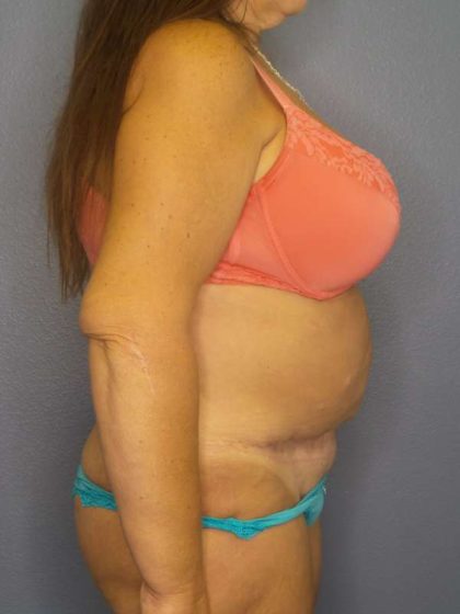 Abdominoplasty Before & After Patient #6797