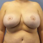 High BMI (Larger Patients) Surgery Before & After Patient #7067