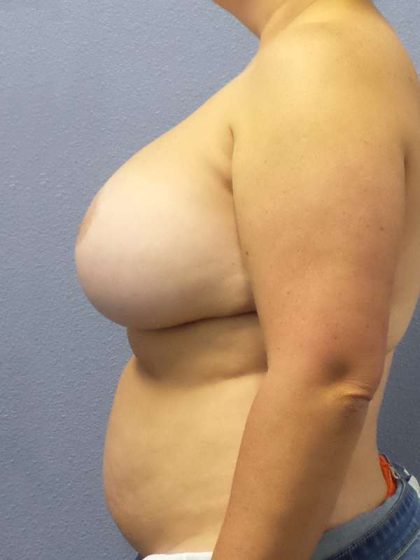 High BMI (Larger Patients) Surgery Before & After Patient #7067