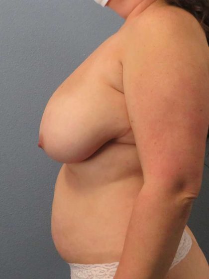 High BMI (Larger Patients) Surgery Before & After Patient #7067