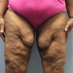 High BMI (Larger Patients) Surgery Before & After Patient #10324