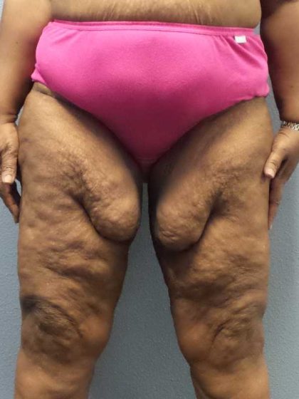 High BMI (Larger Patients) Surgery Before & After Patient #10324