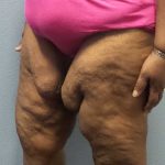 High BMI (Larger Patients) Surgery Before & After Patient #10324