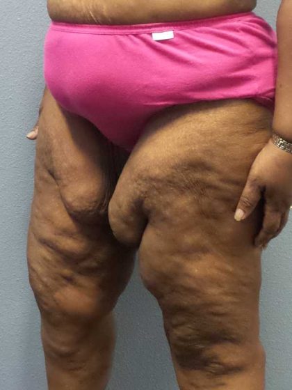 High BMI (Larger Patients) Surgery Before & After Patient #10324