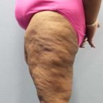 High BMI (Larger Patients) Surgery Before & After Patient #10324