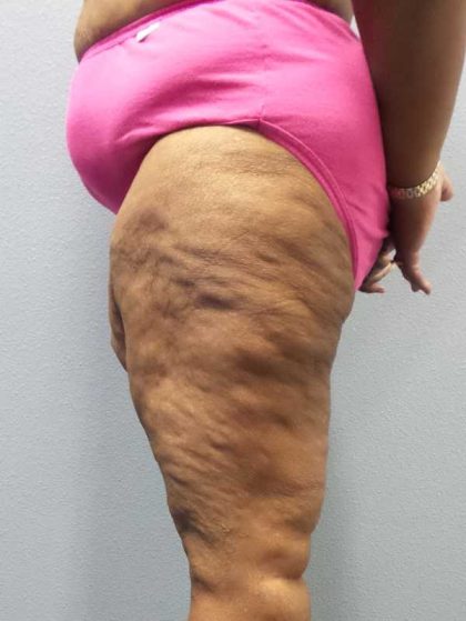 High BMI (Larger Patients) Surgery Before & After Patient #10324