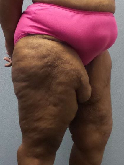 High BMI (Larger Patients) Surgery Before & After Patient #10324
