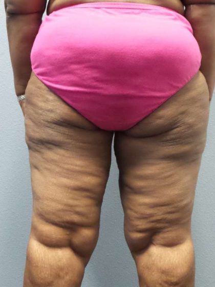 High BMI (Larger Patients) Surgery Before & After Patient #10324