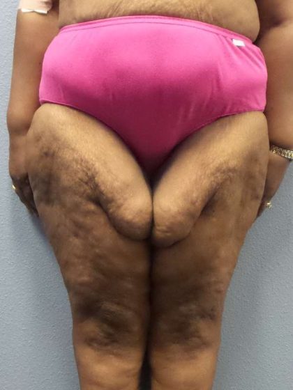 High BMI (Larger Patients) Surgery Before & After Patient #10324