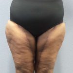High BMI (Larger Patients) Surgery Before & After Patient #10324
