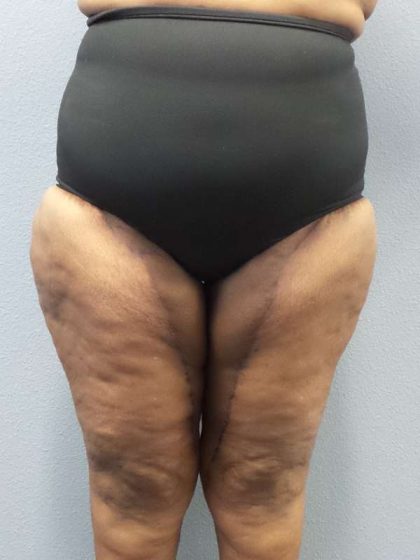 High BMI (Larger Patients) Surgery Before & After Patient #10324