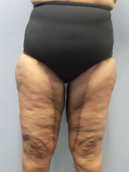 High BMI (Larger Patients) Surgery Before & After Patient #10324