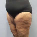 High BMI (Larger Patients) Surgery Before & After Patient #10324