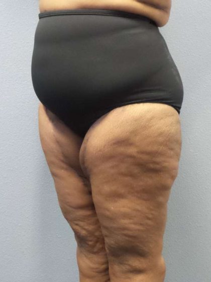 High BMI (Larger Patients) Surgery Before & After Patient #10324