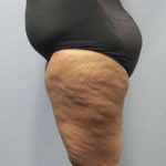 High BMI (Larger Patients) Surgery Before & After Patient #10324