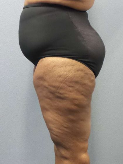 High BMI (Larger Patients) Surgery Before & After Patient #10324