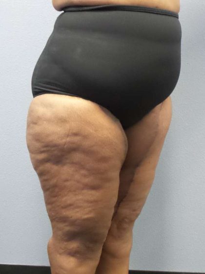 High BMI (Larger Patients) Surgery Before & After Patient #10324