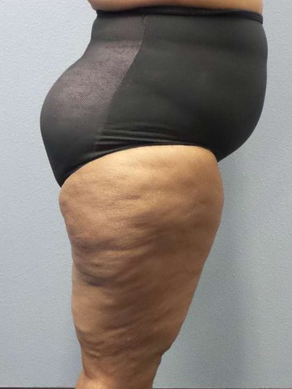 High BMI (Larger Patients) Surgery Before & After Patient #10324