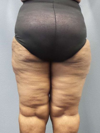 High BMI (Larger Patients) Surgery Before & After Patient #10324