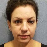 Resurfacing Before & After Patient #8805