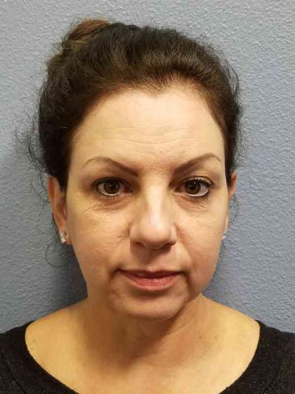 Resurfacing Before & After Patient #8805