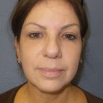 Resurfacing Before & After Patient #8805