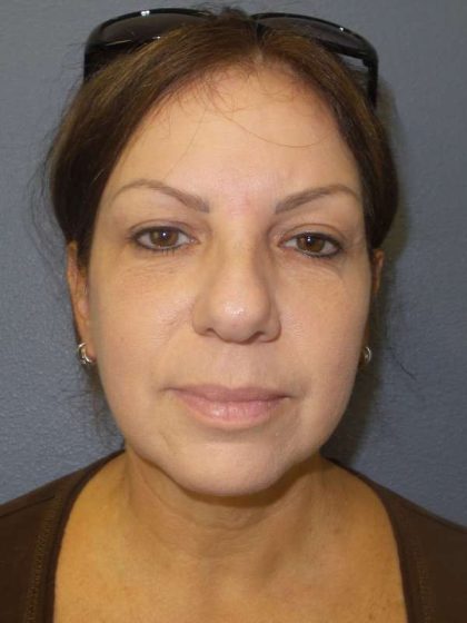 Resurfacing Before & After Patient #8805