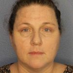 Periorbital Before & After Patient #8527