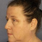 Periorbital Before & After Patient #8527