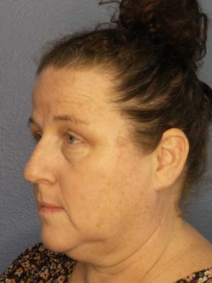 Periorbital Before & After Patient #8527