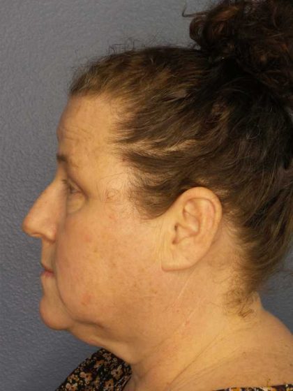 Periorbital Before & After Patient #8527