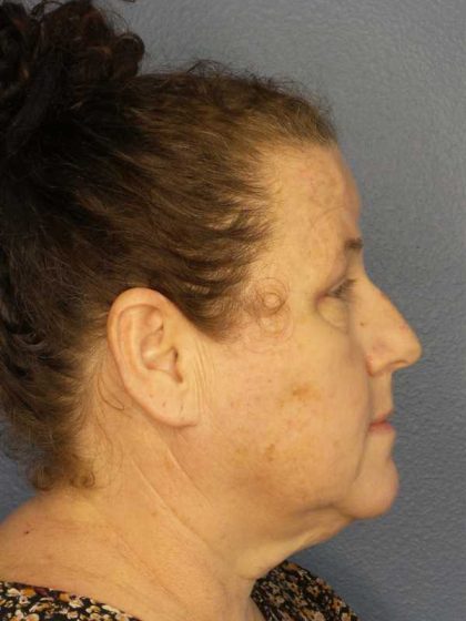 Periorbital Before & After Patient #8527
