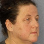 Periorbital Before & After Patient #8527