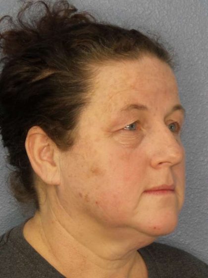 Periorbital Before & After Patient #8527