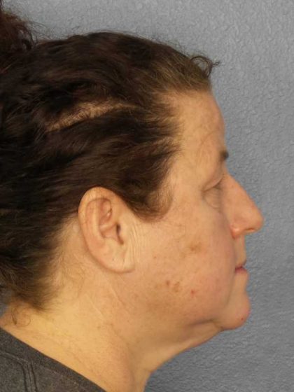 Periorbital Before & After Patient #8527