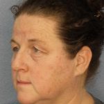 Periorbital Before & After Patient #8527